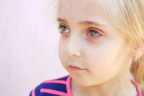 Young child with eye inflammation due to conjunctivitis
