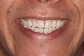 full mouth rehabilitation before