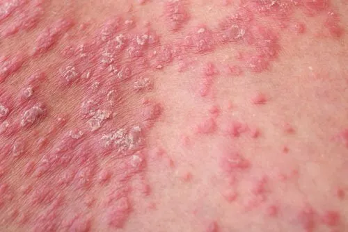 Close-up of skin affected by psoriasis