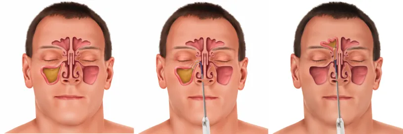 sinus dilation