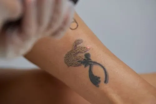 Tattoo Removal