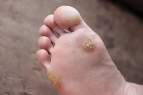 Foot affected by a hard corn on the skin
