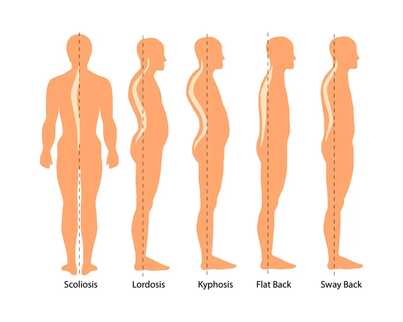 posture chart