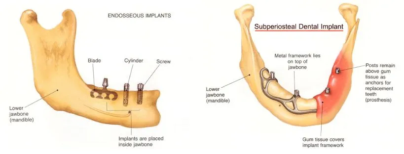 Types of Dental Implants| Birmingham, Rochester MI