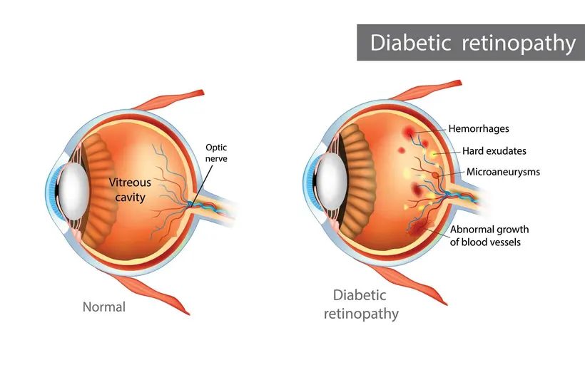 diabetic diseases