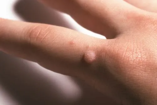 Close-up of warts on a person's finger