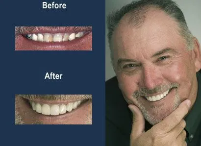 replace failing dental bridge