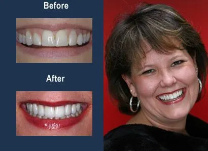 Braces, Gum Lift Surgery, Veneers 