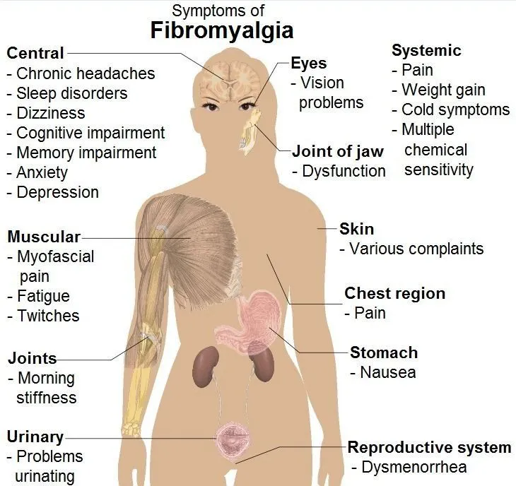 fibromyalgia