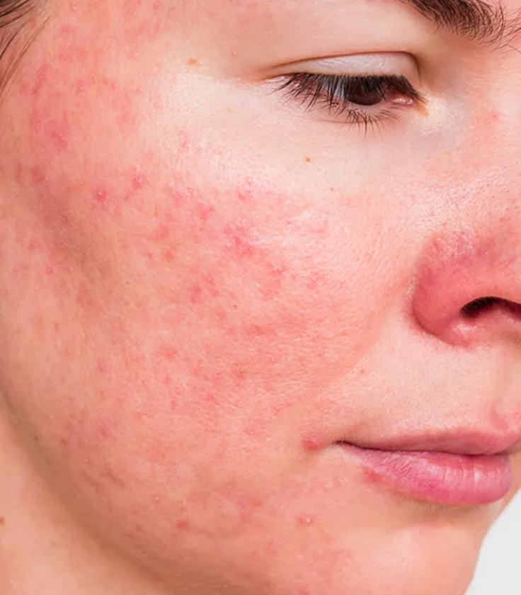 Rosacea in Tulsa, OK