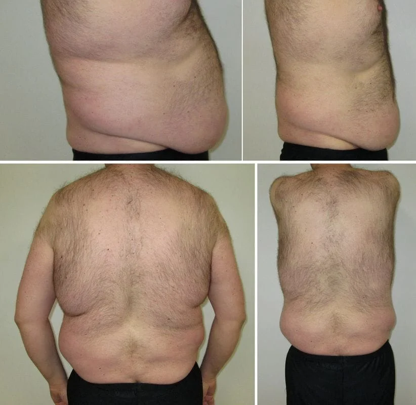 Liposuction in Overland Park, KS