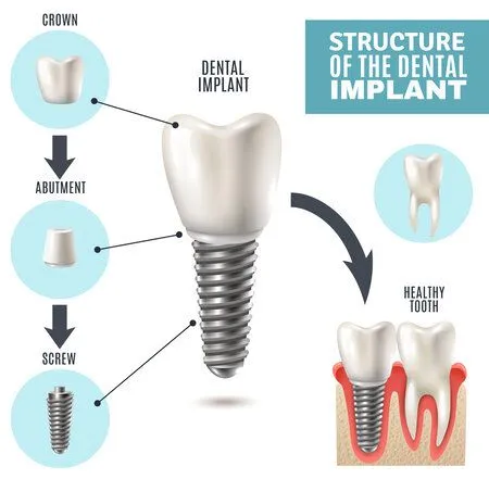 "Structure of the Dental Implant" illustrated diagram showing implant parts and assembly, dental implants Frederick, MD dentist 