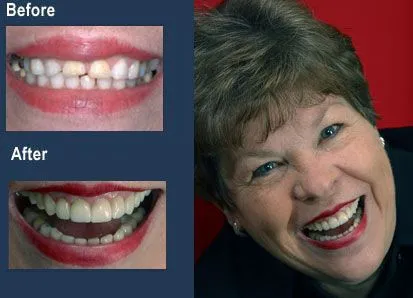 smile design with porcelain crowns