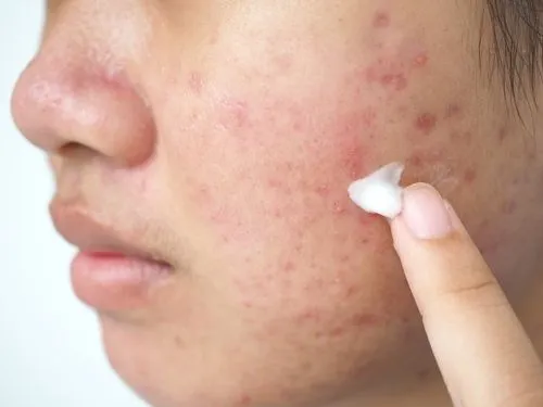 Woman applying topical acne medication to her face