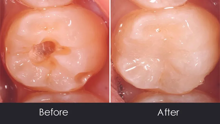 Before and After of cavity in tooth then fixed with cosmetic filling Royal Palm Beach, FL dentist