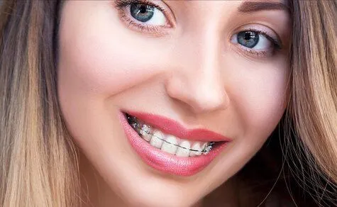 close up of girl's face, smiling showing clear braces on teeth, clear braces Sioux Falls, SD orthodontist