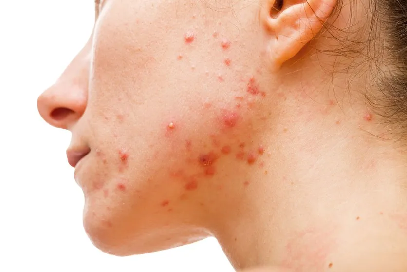 Acne Treatment in Palm Beach Gardens, FL