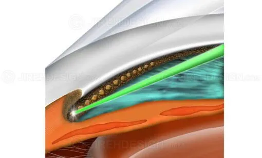 Laser positioned at trabecular meshwork