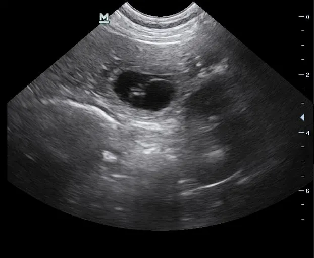 Pregnancy Ultrasound