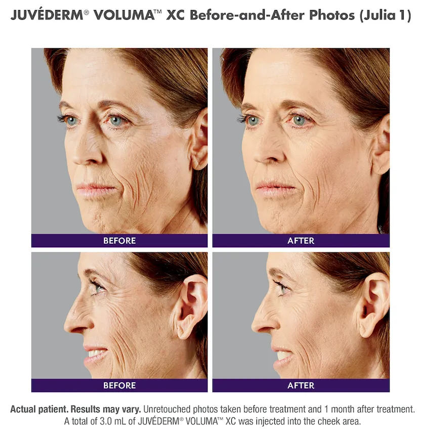 Juvéderm Before and After