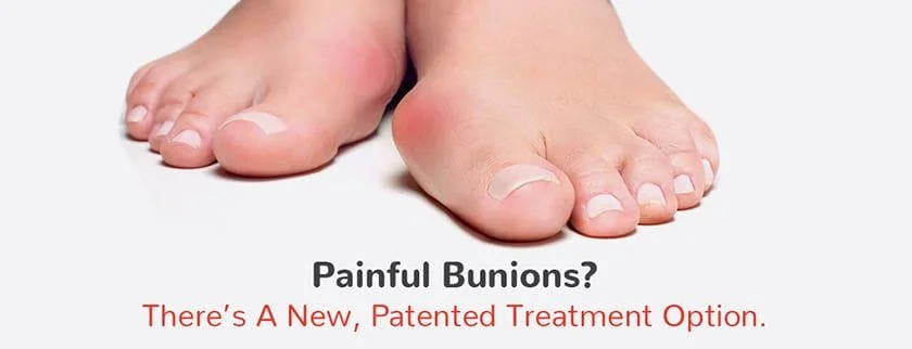 Lapiplasty - the new, patented bunion treatment