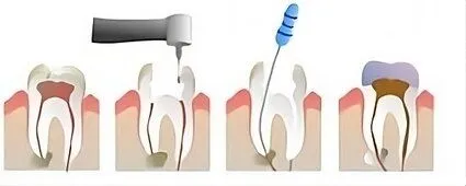 step by step illustration of root canal procedure on infected tooth, dentist Elgin, IL root canal treatment
