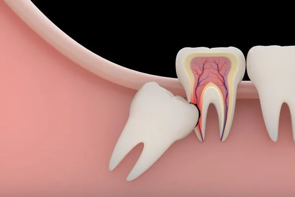 wisdom tooth xb