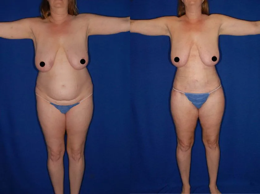 HourGlass Tummy Tuck