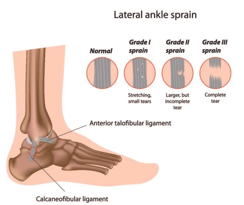 Ankle Sprain