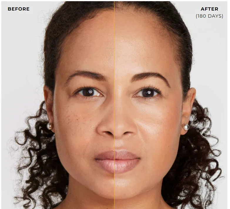 Ultherapy before/after