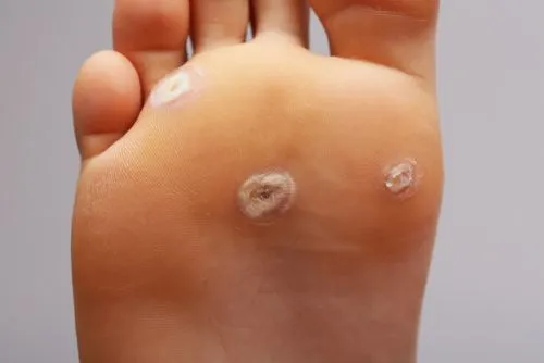 Close-up of plantar warts on the sole of the foot
