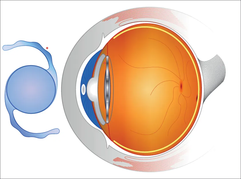 Intraocular Lenses