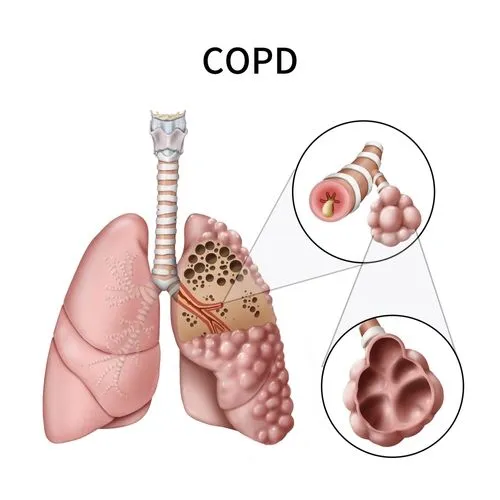 3D graphic of chronic obstructive pulmonary disease