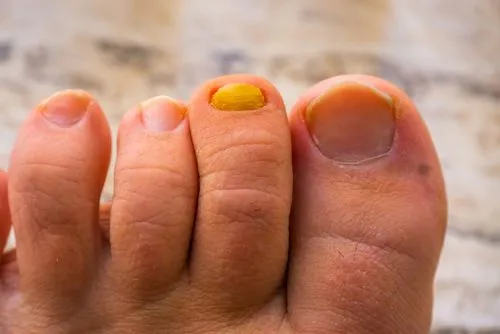 Close-up of a toenail affected by fungal infection