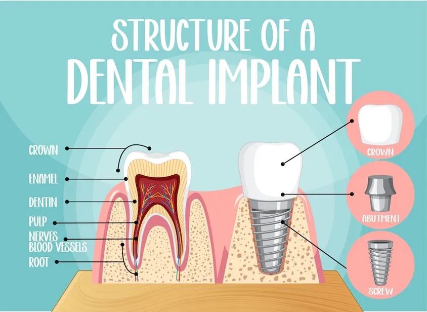 Dental Implants