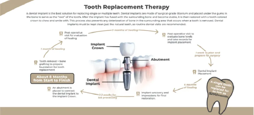 illustration of how implants are used to replace teeth, dental implants Brookline, MA implant dentistry