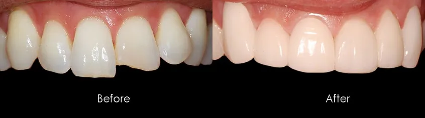 Before and After Chipped Tooth