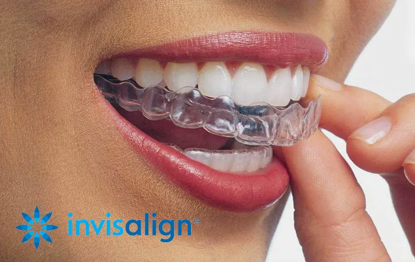 invisalign Morrilton, Perryville, Atkins AR