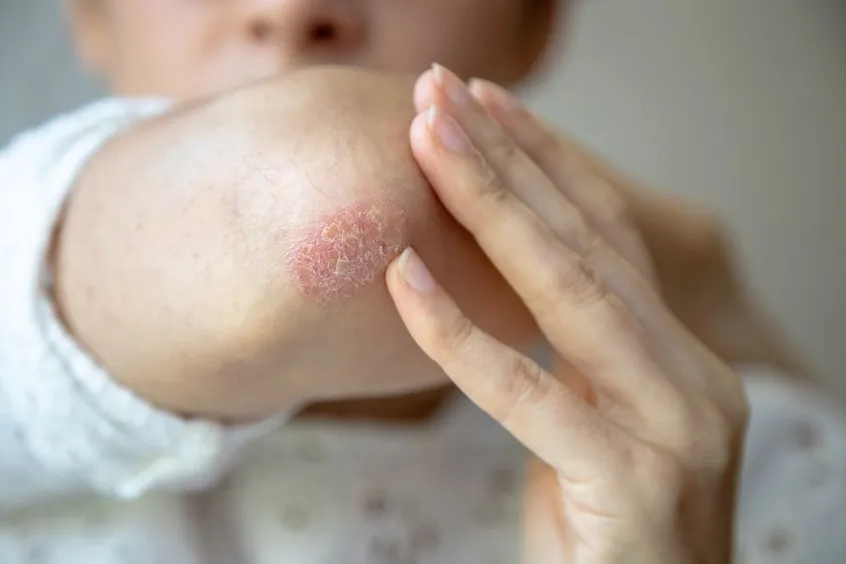 Psoriasis in Tarzana & Simi Valley, CA