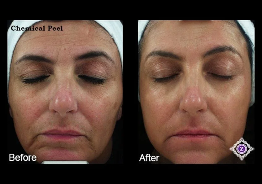 Chemical Peels - Dermatologist In Baton Rouge, La | Z Aesthetic Dermatology  Llc