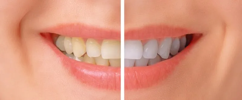 teeth whitening in Wichita, KS