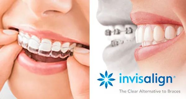 Invisalign in Reston, VA