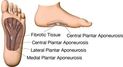 Plantar_Fibroma_1.jpg