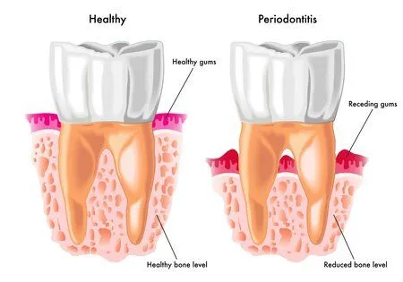 illustration of healthy tooth next to tooth with periodontitis, periodontal disease Albuquerque, NM gum disease treatment