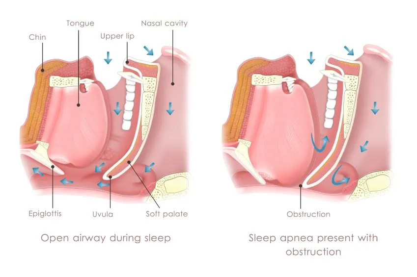 Oral Appliance for Sleep Apnea Cedar Rapids, IA