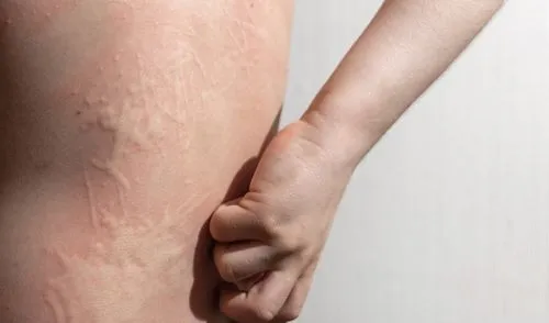Young patient showing allergic hives on his back
