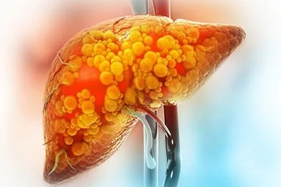 Medical illustration showing fatty liver disease