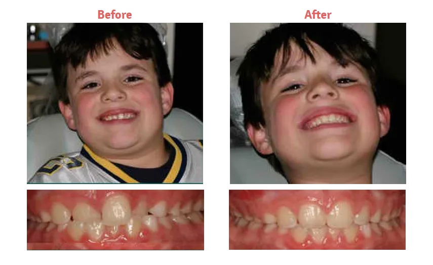 before and after image of young dark haired boy and his teeth, showing results of treatment with orthodontics New Baltimore, MI dentist 