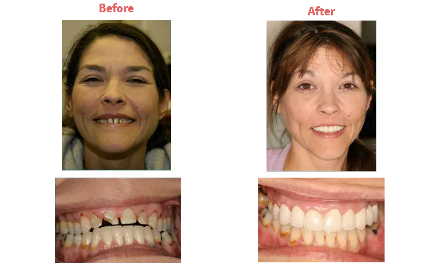 collage of before and after photos of woman with chipped, damaged teeth then after veneers teeth are fixed and whiter. Veneers New Baltimore, MI
