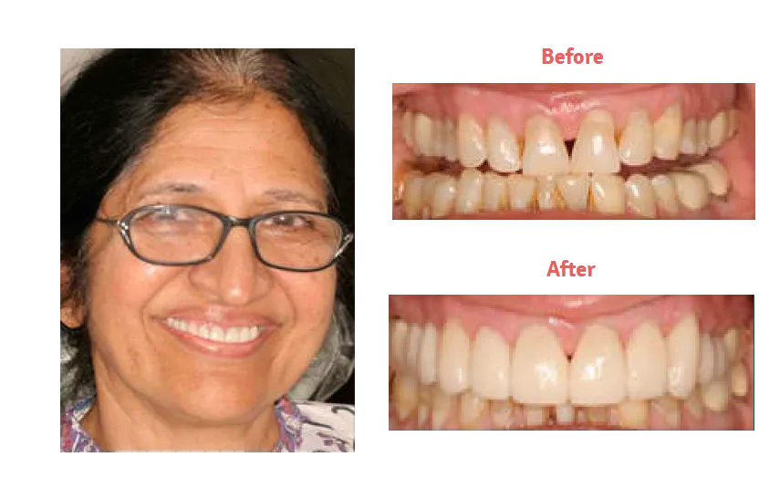 woman with glasses, before and after image of misshapen teeth with gaps, then corrected with dental veneers New Baltimore, MI dentist